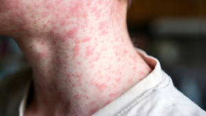 সারাদেশে স্বাস্থ্যকর্মীদের ছুটি বাতিল