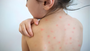 দেশে হঠাৎ শিশুদের মধ্যে হামের প্রকোপ কেন, কী ব্যবস্থা নিচ্ছে সরকার