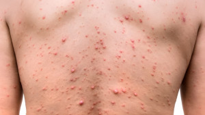 সারাদেশে ছড়াচ্ছে হাম, সর্বোচ্চ সংক্রমণ ঢাকায়